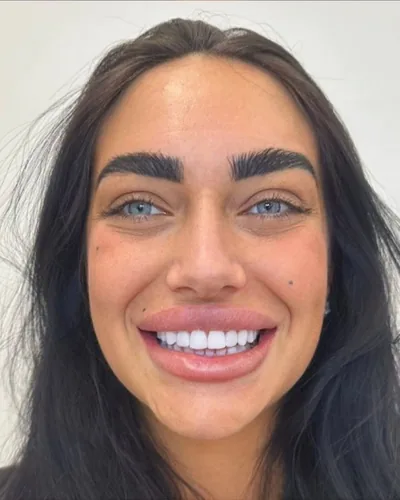 Dezelfde patiënte na haar composiet Hollywood Smile