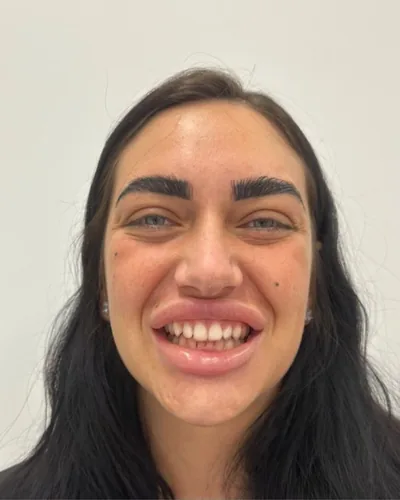Patiënte van Qualident voor haar composiet Hollywood Smile